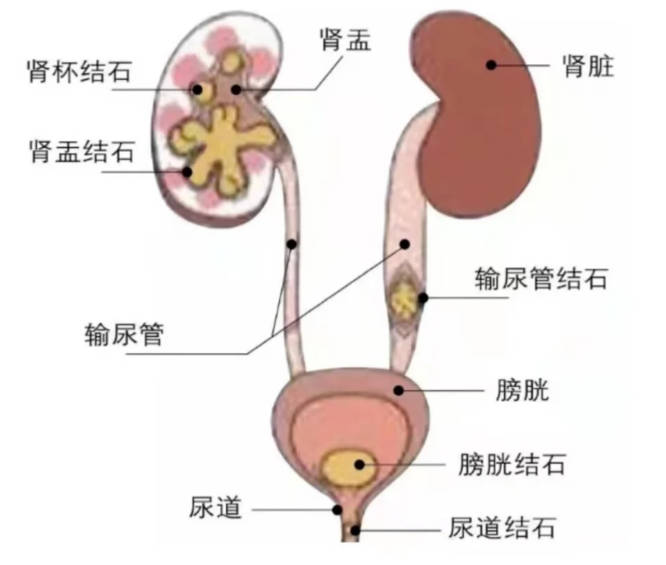 哪些抗生素长期大量服用可能导致尿路结石?