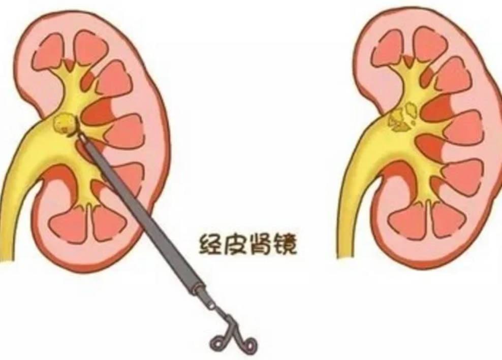 肾结石疼痛难忍?如何快速止痛?