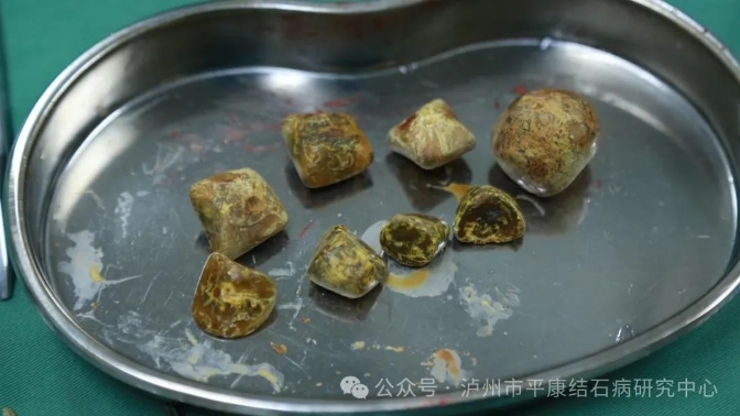 什么是不切胆取石?