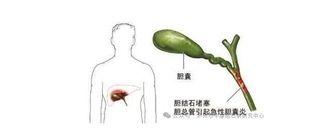 泸州平康结石病研究中心:排石药无法排出结石,微创手术才是正解