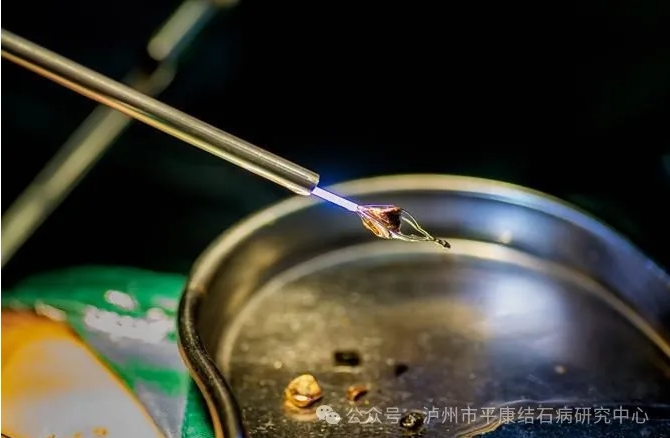 微创不切胆取石术,让你不再害怕手术治疗!